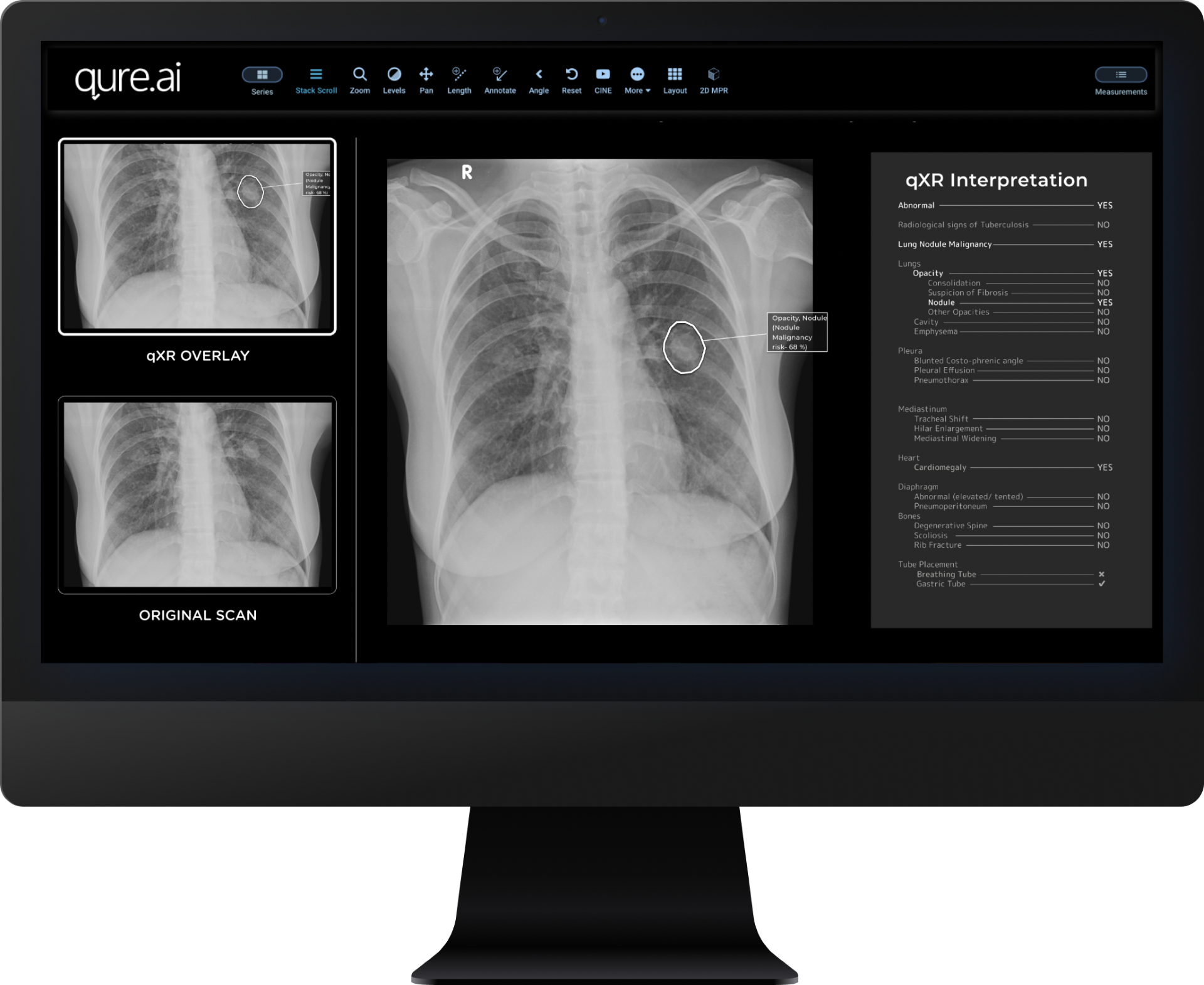 Qure.ai Announces Receipt of FDA Clearance for Chest X-ray